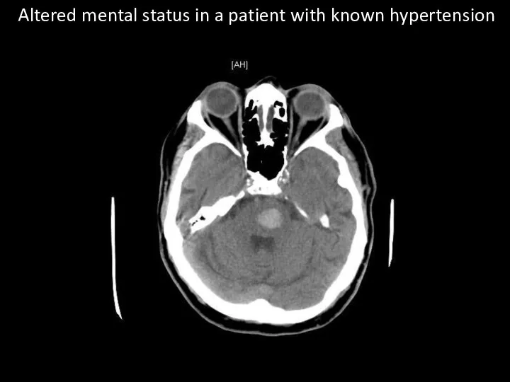 Altered mental status in a patient with known hypertension