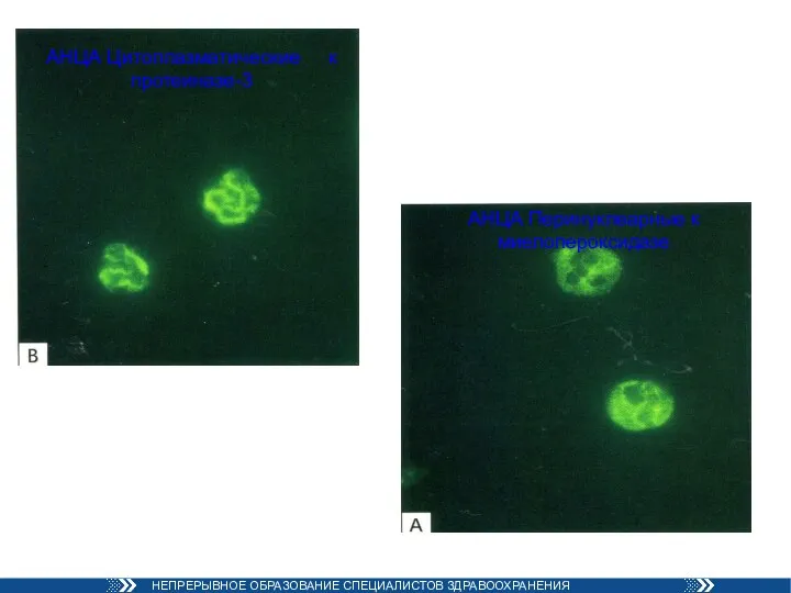 АНЦА Цитоплазматические к протеиназе-3 АНЦА Перинуклеарные к миелопероксидазе