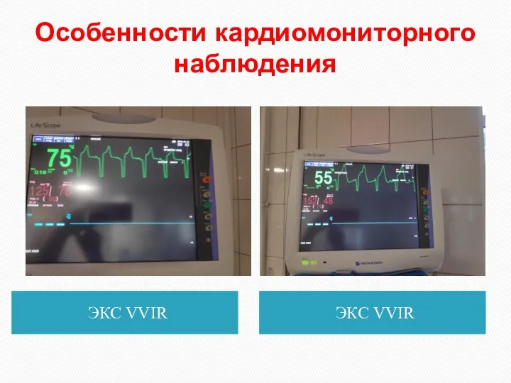 Особенности кардиомониторного наблюдения ЭКС VVIR ЭКС VVIR