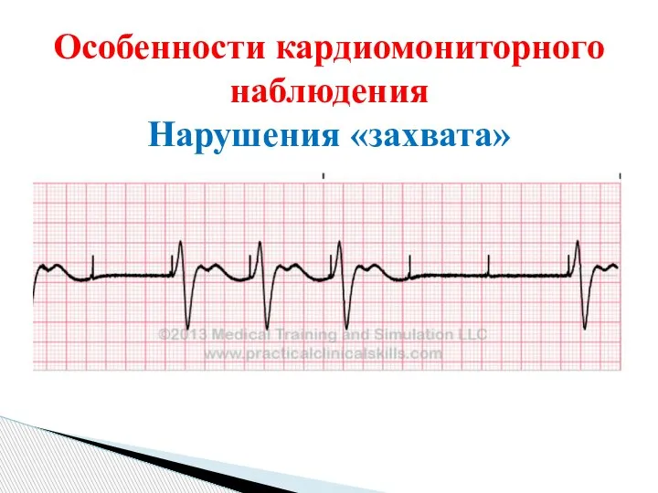Особенности кардиомониторного наблюдения Нарушения «захвата»