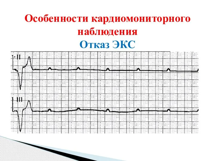 Особенности кардиомониторного наблюдения Отказ ЭКС