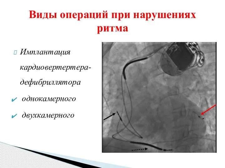 Виды операций при нарушениях ритма Имплантация кардиовертертера-дефибриллятора однокамерного двухкамерного