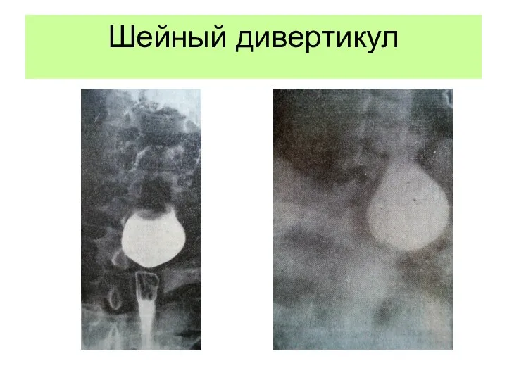 Шейный дивертикул