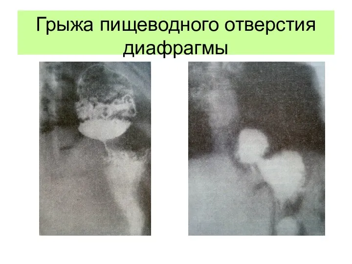 Грыжа пищеводного отверстия диафрагмы