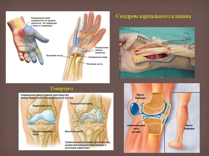 Синдром карпального клапана Гонартроз