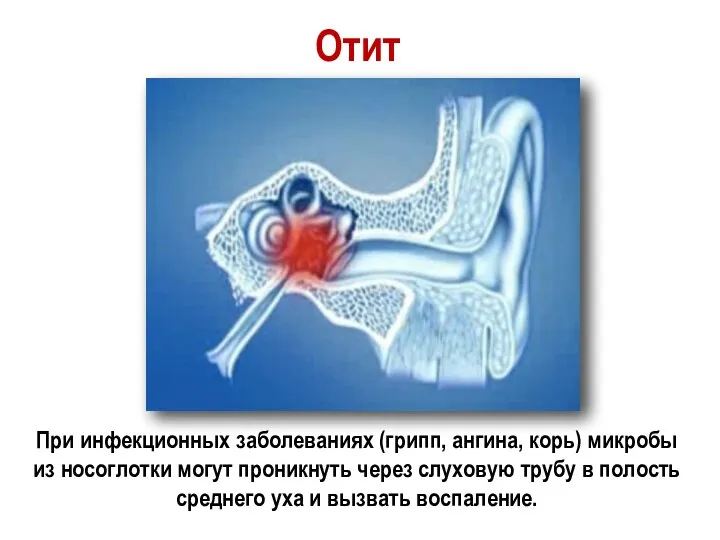 Отит При инфекционных заболеваниях (грипп, ангина, корь) микробы из носоглотки могут проникнуть