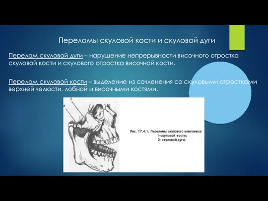 Переломы скуловой кости и скуловой дуги Перелом скуловой дуги – нарушение непрерывности