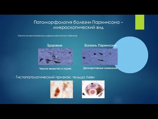 Патоморфология болезни Паркинсона – микроскопический вид Здоровые Утрата пигментированных дофаминэргических нейронов Болезнь