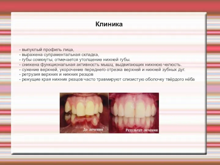 Клиника - выпуклый профиль лица, - выражена супраментальная складка, - губы сомкнуты,