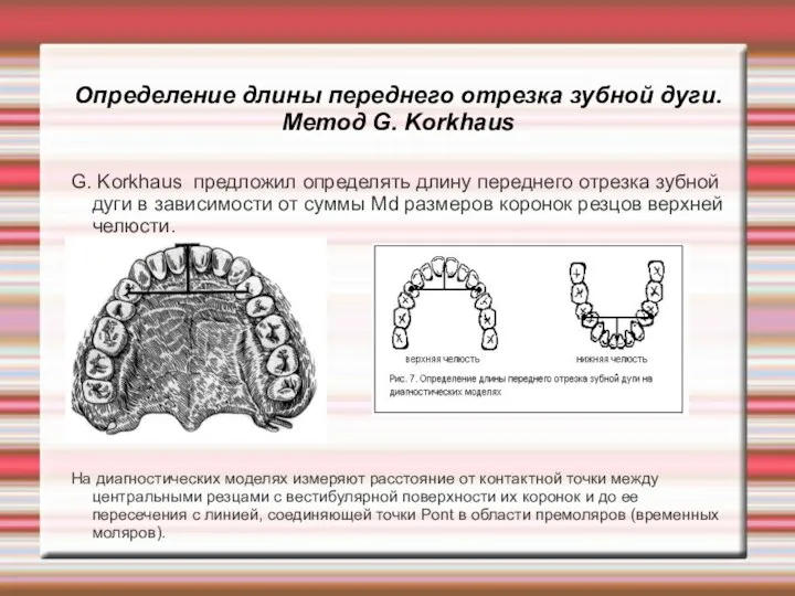 Определение длины переднего отрезка зубной дуги. Метод G. Korkhaus G. Korkhaus предложил