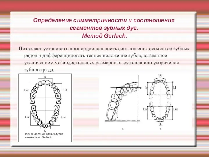 Определение симметричности и соотношения сегментов зубных дуг. Метод Gerlach. Позволяет установить пропорциональность