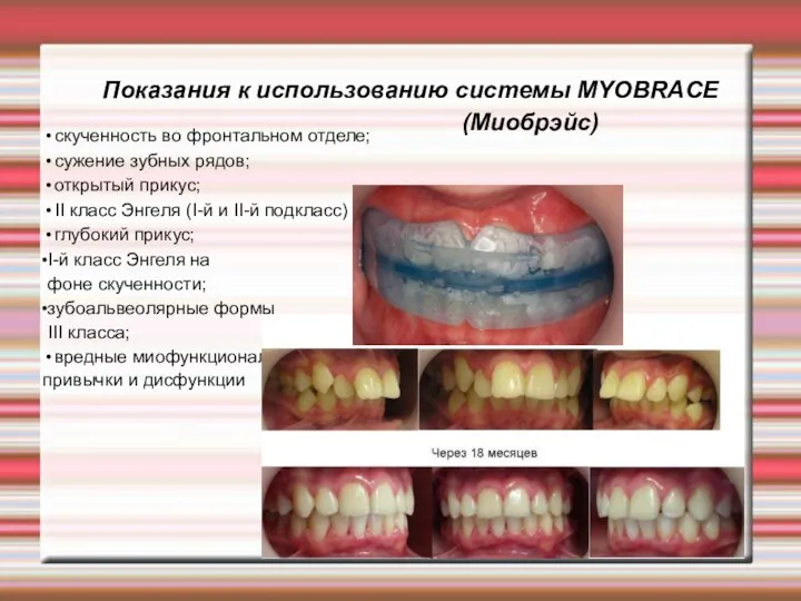 Показания к использованию системы MYOBRACE (Миобрэйс) скученность во фронтальном отделе; сужение зубных