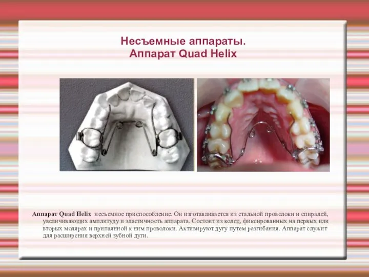 Несъемные аппараты. Аппарат Quad Helix Аппарат Quad Helix несъемное приспособление. Он изготавливается