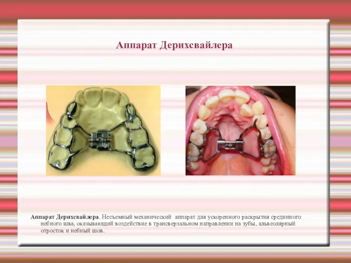 Аппарат Дерихсвайлера Аппарат Дерихсвайлера. Несъемный механический аппарат для ускоренного раскрытия срединного небного