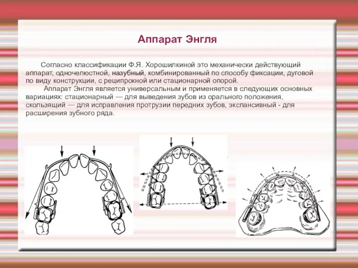 Аппарат Энгля Согласно классификации Ф.Я. Хорошилкиной это механически действующий аппарат, одночелюстной, назубный,