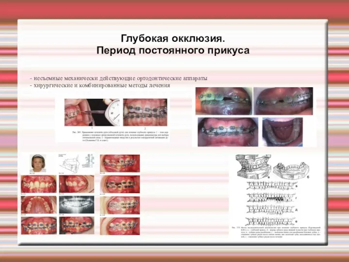 Глубокая окклюзия. Период постоянного прикуса - несъемные механически действующие ортодонтические аппараты -