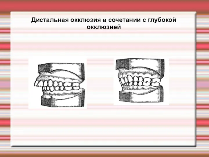 Дистальная окклюзия в сочетании с глубокой окклюзией