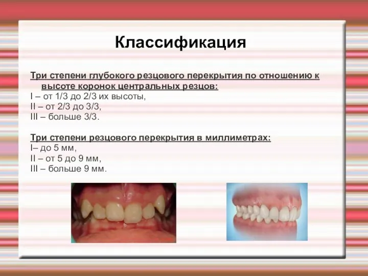 Классификация Три степени глубокого резцового перекрытия по отношению к высоте коронок центральных