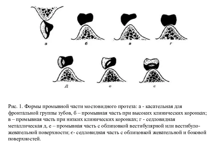 Рис. 1. Формы промывной части мостовидного протеза: а - касательная для фронтальной