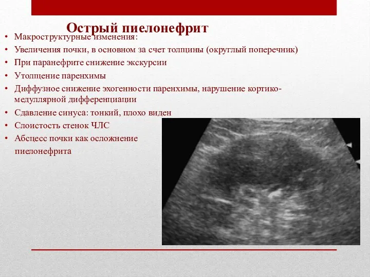 Острый пиелонефрит Макроструктурные изменения: Увеличения почки, в основном за счет толщины (округлый