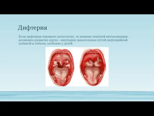 Дифтерия Если дифтерия поражает ротоглотку, то помимо тяжёлой интоксикации, возможно развитие крупа