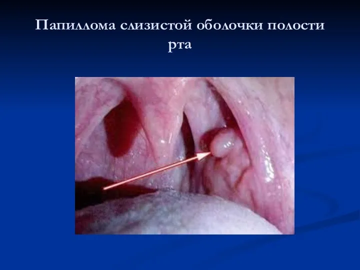Папиллома слизистой оболочки полости рта