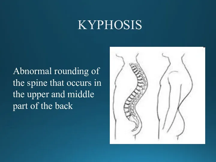 KYPHOSIS Abnormal rounding of the spine that occurs in the upper and