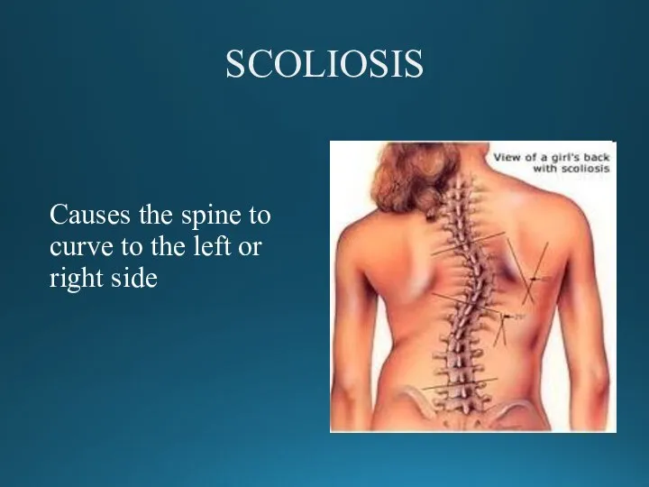 SCOLIOSIS Causes the spine to curve to the left or right side