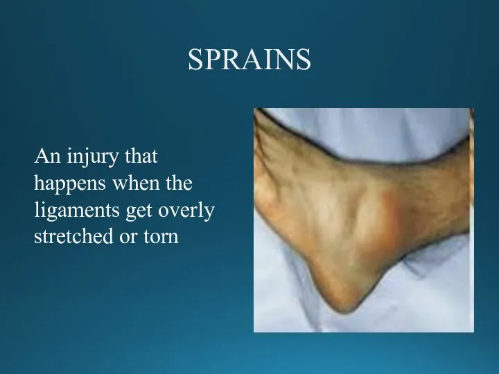 SPRAINS An injury that happens when the ligaments get overly stretched or torn