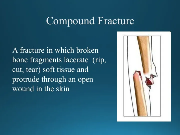 Compound Fracture A fracture in which broken bone fragments lacerate (rip, cut,