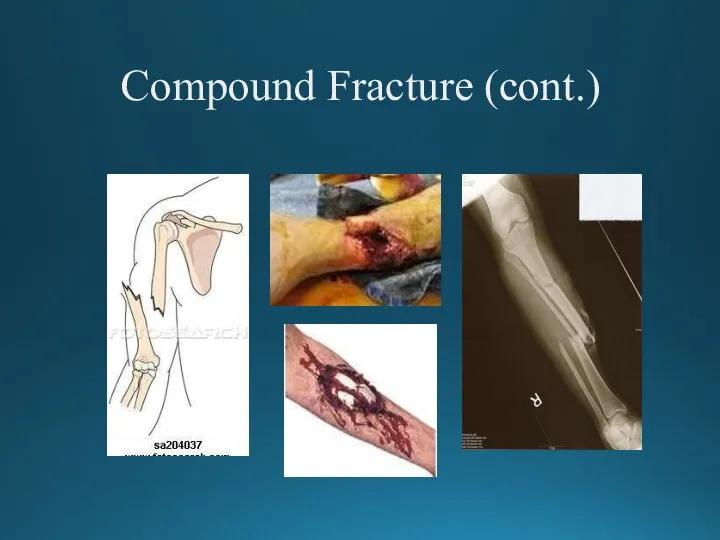 Compound Fracture (cont.)
