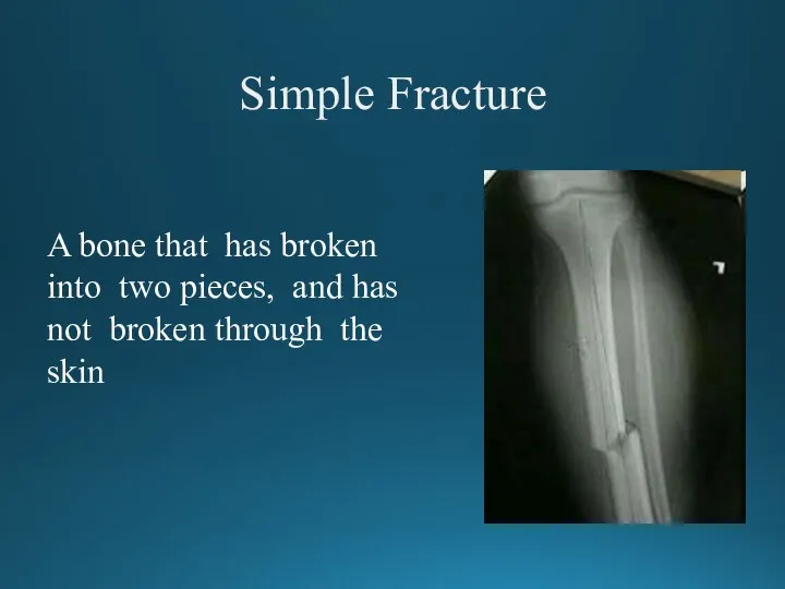 Simple Fracture A bone that has broken into two pieces, and has