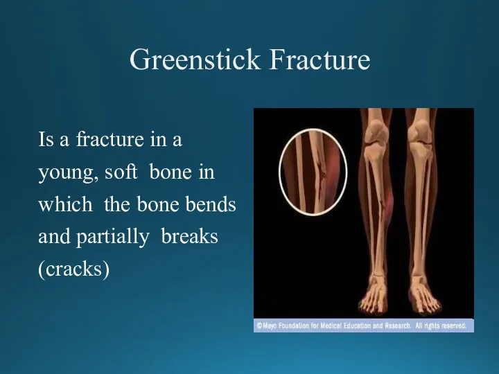 Greenstick Fracture Is a fracture in a young, soft bone in which