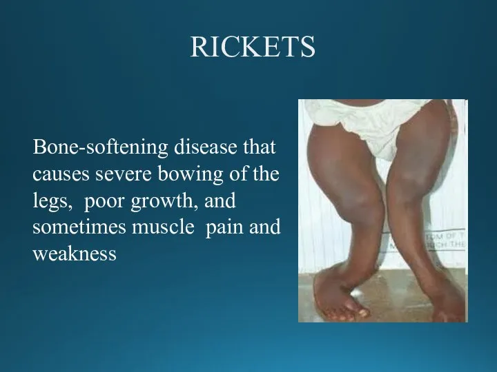 RICKETS Bone-softening disease that causes severe bowing of the legs, poor growth,