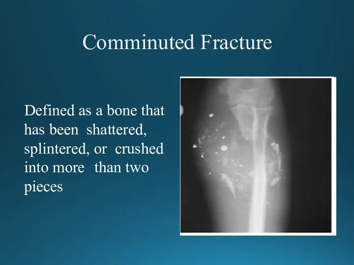 Comminuted Fracture Defined as a bone that has been shattered, splintered, or