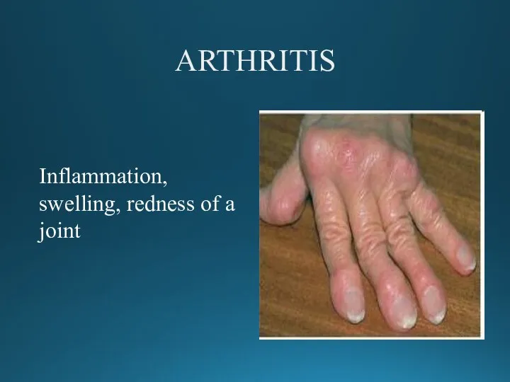 ARTHRITIS Inflammation, swelling, redness of a joint
