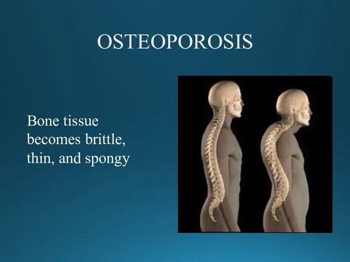 OSTEOPOROSIS Bone tissue becomes brittle, thin, and spongy