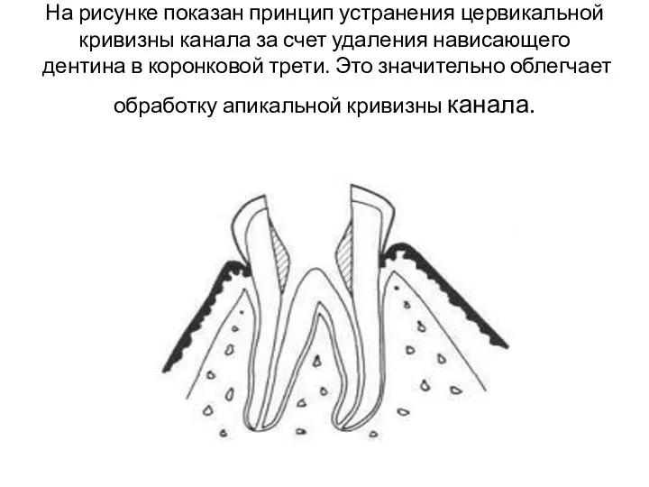 На рисунке показан принцип устранения цервикальной кривизны канала за счет удаления нависающего