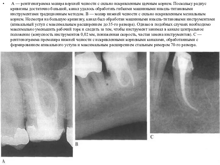 А — рентгенограмма моляра верхней челюсти с сильно искривленным щечным корнем. Поскольку