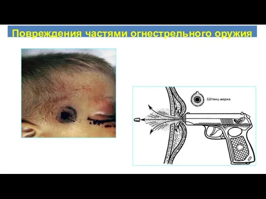 Повреждения частями огнестрельного оружия