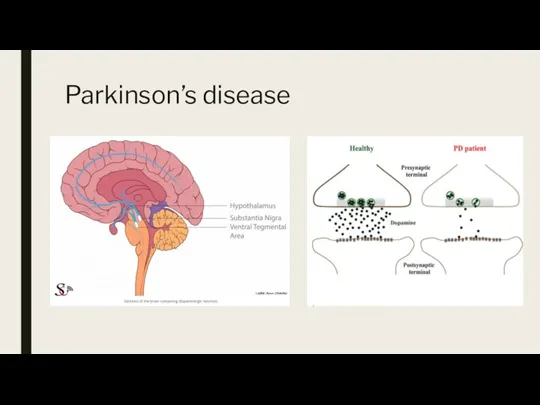 Parkinson’s disease