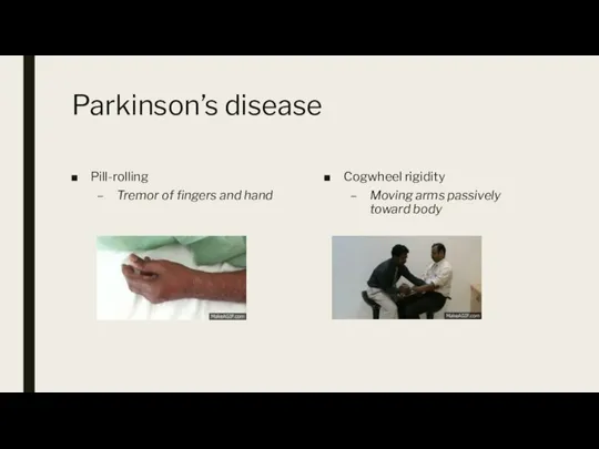 Parkinson’s disease Pill-rolling Tremor of fingers and hand Cogwheel rigidity Moving arms passively toward body