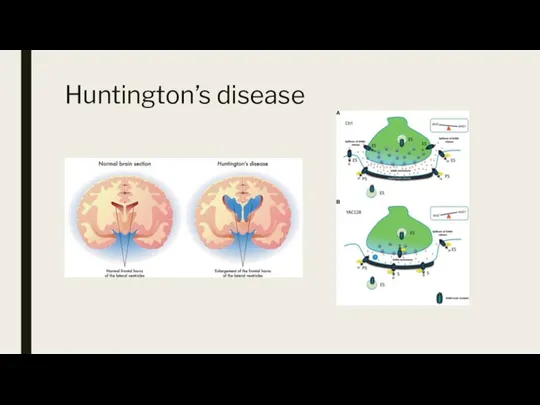 Huntington’s disease