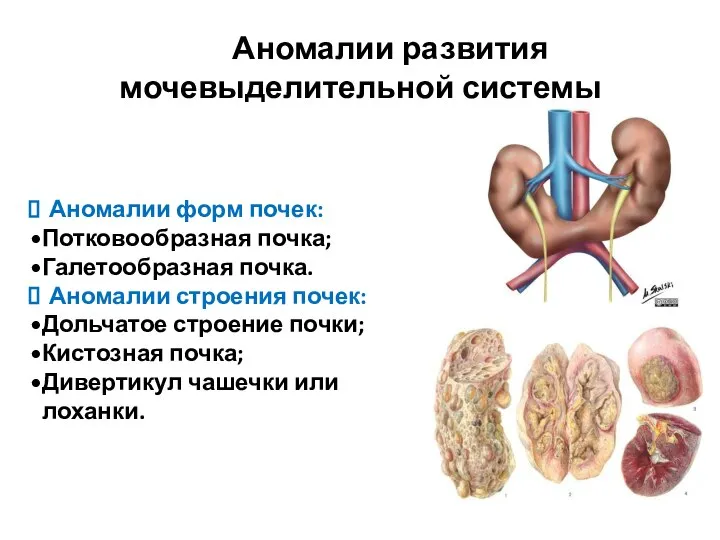 Аномалии развития мочевыделительной системы Аномалии форм почек: Потковообразная почка; Галетообразная почка. Аномалии