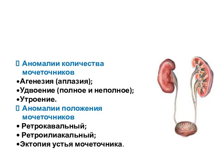 Аномалии количества мочеточников Агенезия (аплазия); Удвоение (полное и неполное); Утроение. Аномалии положения