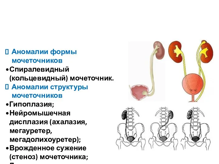 Аномалии формы мочеточников Спиралевидный (кольцевидный) мочеточник. Аномалии структуры мочеточников Гипоплазия; Нейромышечная дисплазия