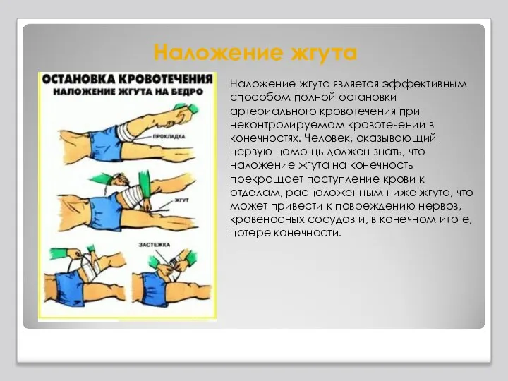 Наложение жгута Наложение жгута является эффективным способом полной остановки артериального кровотечения при