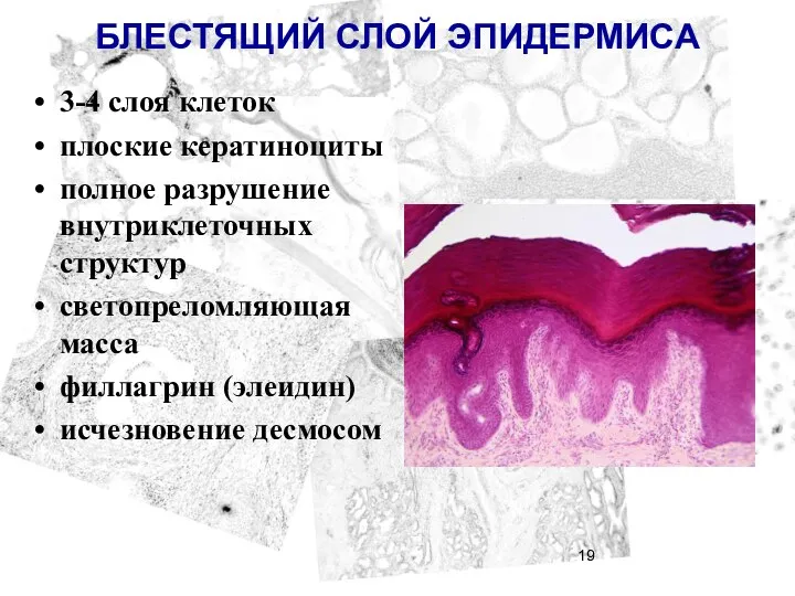 БЛЕСТЯЩИЙ СЛОЙ ЭПИДЕРМИСА 3-4 слоя клеток плоские кератиноциты полное разрушение внутриклеточных структур