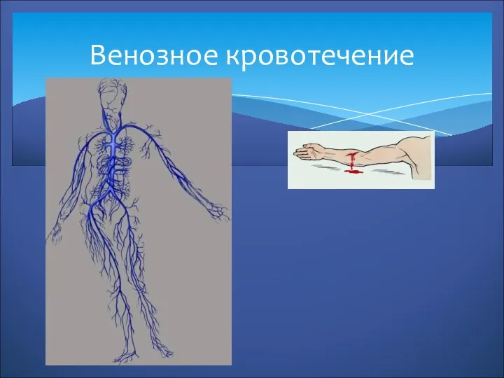 Венозное кровотечение