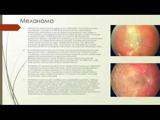 Меланома Метастазы меланомы в сосудистую оболочку глаза (хориоидею) составляют примерно 2–3% всех